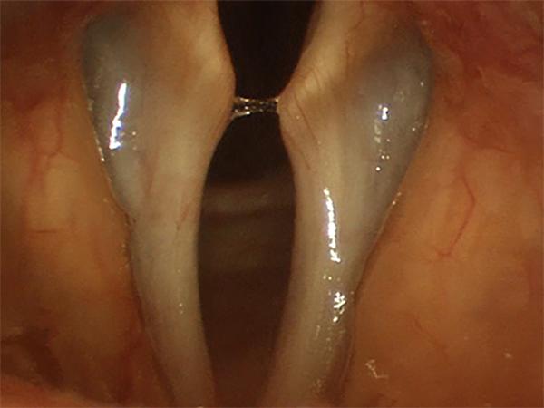 Thinning of Vocal Fold Tissues Causes the Vocal Fold Margin To Appear Scalloped or Concave