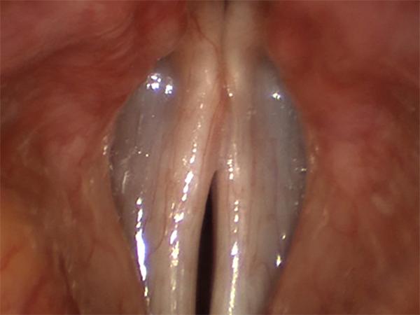 Thinned Vocal Folds are Not Able to Close Completely During Voicing, and Leave a Characteristic Spindle-Shaped Gap