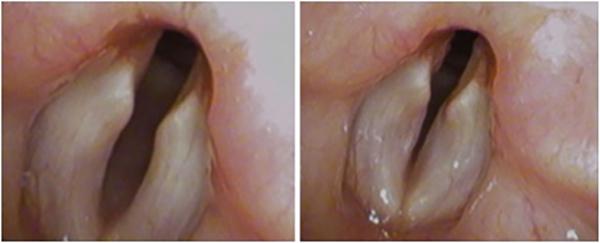 Patients with bilateral vocal fold palsy have more trouble (and make more noise, called “stridor”) breathing in than breathing out. These images show why. At left, the patient is exhaling. At right, the patient is inhaling. The suction of the inhalation d