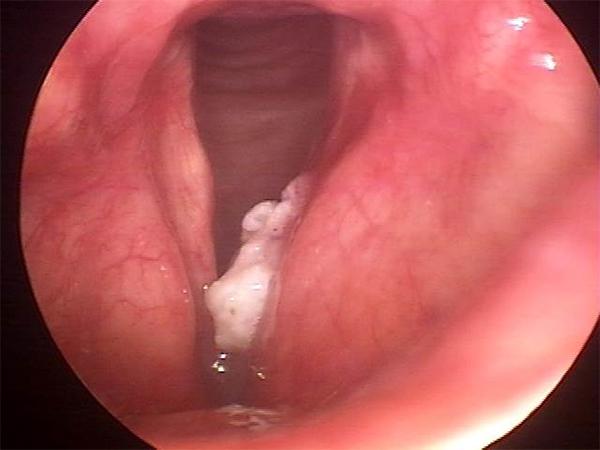 The Irregular White Mass of the Left Vocal Fold (Right in the Image) is a Cancer