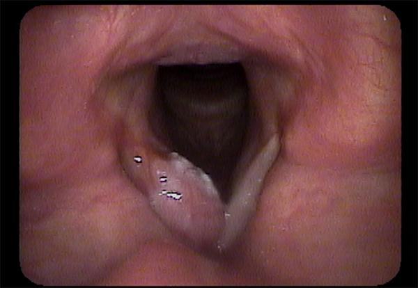 The Bulky Rounded Mass on the Right Vocal Fold (Left in the Image) is an Early Vocal Cord Cancer