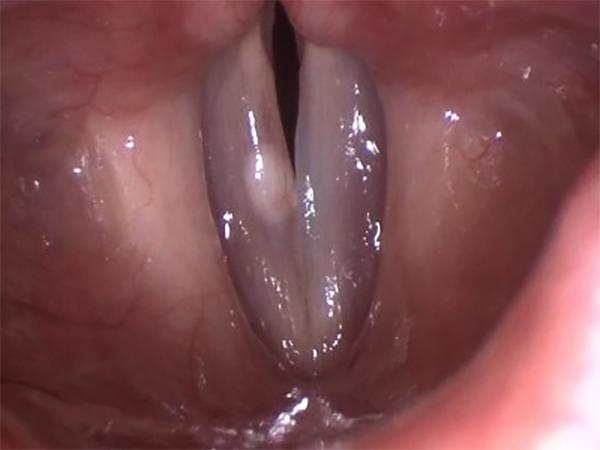 An Ovoid Cyst is Visible Underneath the Covering ("Epithelium") of the Vocal Fold