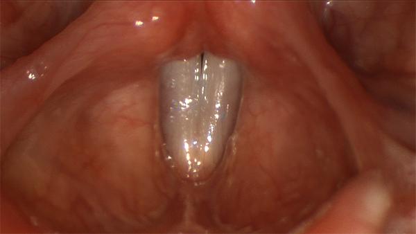 Vocal folds in the open position for breathing