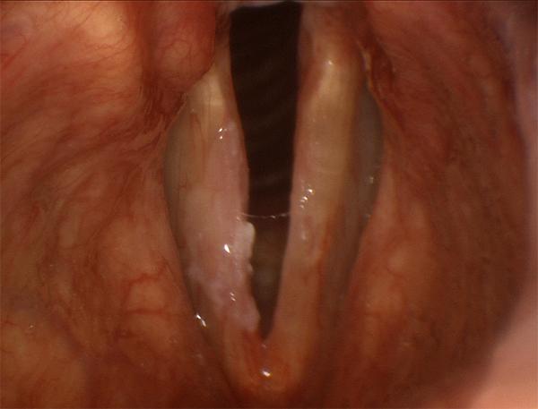 Leukoplakia