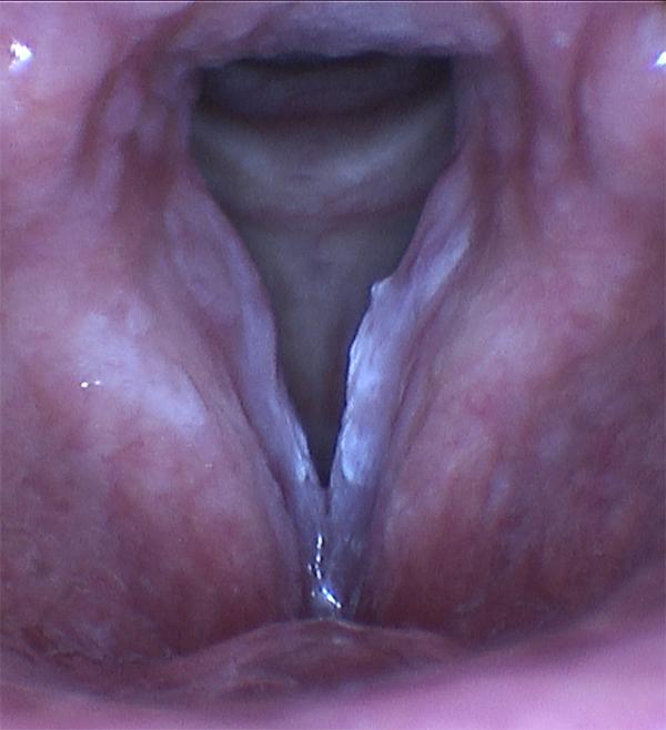 Leukoplakie postihující obě hlasivky, a to převážně levou (na obrázku pravá strana). Tento pacient je silný kuřák, který se prezentoval změnami hlasu zhoršujícími se v průběhu několika let.