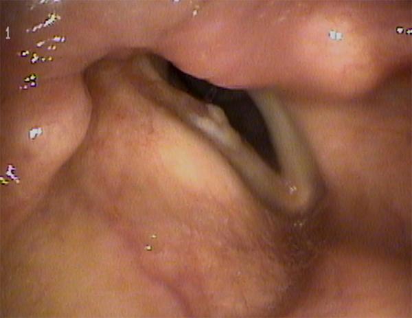 Erythroleukoplakia of the right vocal fold - this lesion combines white and red elements in a “patchwork” formation