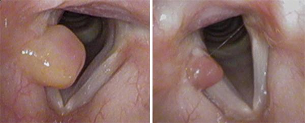 Granulomas are often amenable to medical – as opposed to surgical – management. This bulky left-sided granuloma (left) reduced in size considerably after four weeks of treatment with medication alone (right)