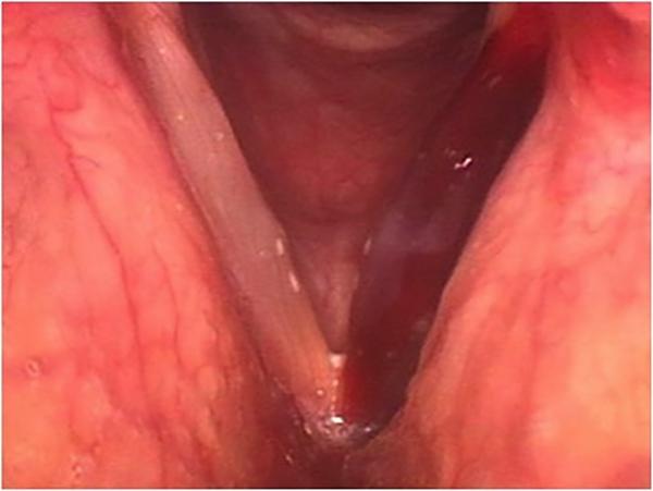 The whole left vocal fold (right in the picture) has turned deep red from a hemorrhage.
