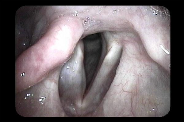 Vocal Fold Injection