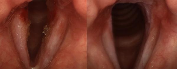 Before (left) and after (right) treatment views of a case of bacterial laryngitis. Initially, the vocal folds are swollen, with redness and crusting. Pus is visible at the bottom of the picture. After a course of antibiotics, some inflammation remains, bu