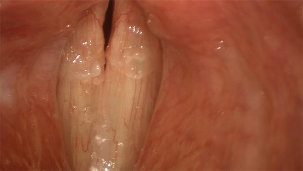 These vocal folds show the signs of an early viral laryngitis. The vocal folds are bloodshot and there is an excess of mucus.