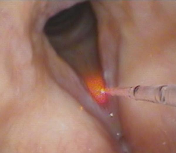 View of the laser fiber making its approach to the vocal folds. The red aiming beam is used to optimize the surgeon’s precision in targeting the areas to be treated.