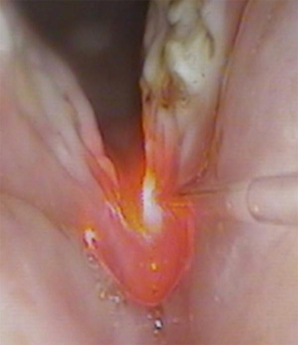 The laser fiber makes precise contact with the area needing treatment. The lesion seen here on the right side of the picture is a premalignant leukoplakia of the vocal fold.