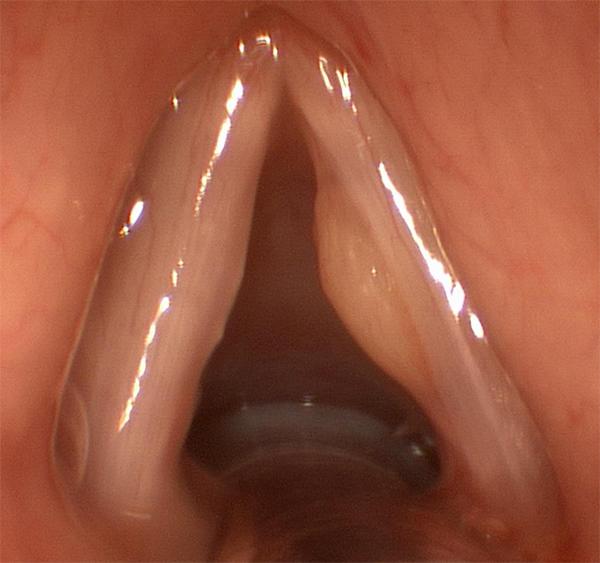 Microscopic Laryngeal Surgery