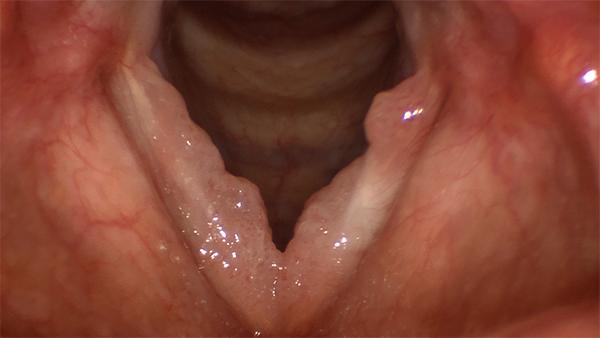 human laryngeal papilloma)