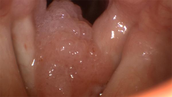 Papilloma tongue removal