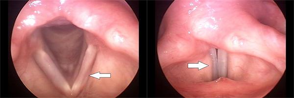 Vocal Fold Paresis