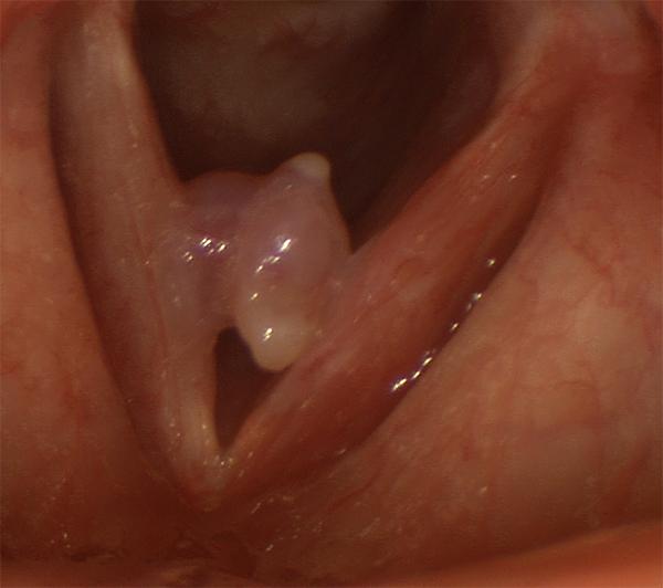 A longstanding polyp that has become very oddly shaped