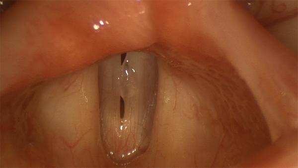 A patient with a pseudocyst of the left vocal fold. In appearance, it is similar to a blister. 