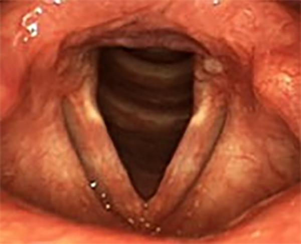 vocal cords damaged