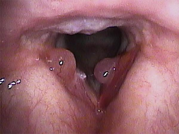 Reinke’s edema can be uneven and irregular making it appear as if there are a number of separate masses. In addition, there is a hemorrhage of one vocal fold in this patient.