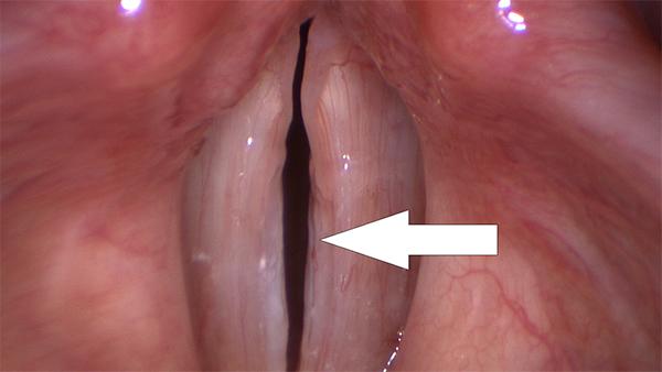 The subtle groove (arrow) on the edge of the vocal fold on the right of the image represents a sulcus vocalis.