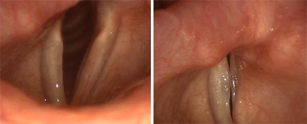 The vocal fold on the left of both images is paralyzed. Even with extreme effort, the opposite vocal fold cannot meet its partner (right).